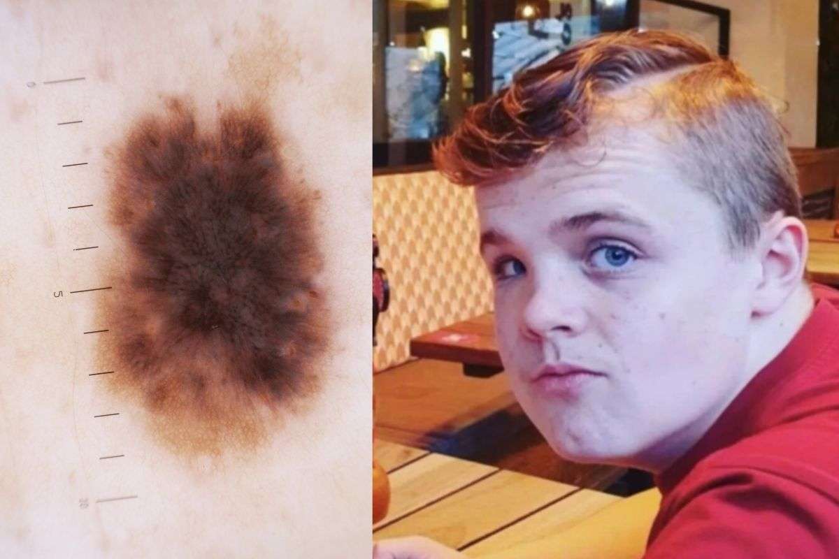 Il malanoma cutaneo